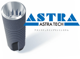 ＡＳＴＬＡ・ＩＴＩ・Nobelのインプラント